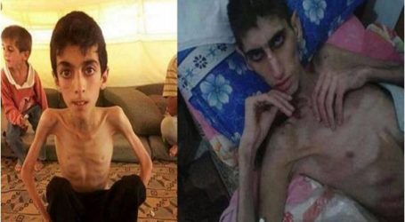 يونيسف تؤكد رصد حالات سوء تغذية «حاد» في مضايا